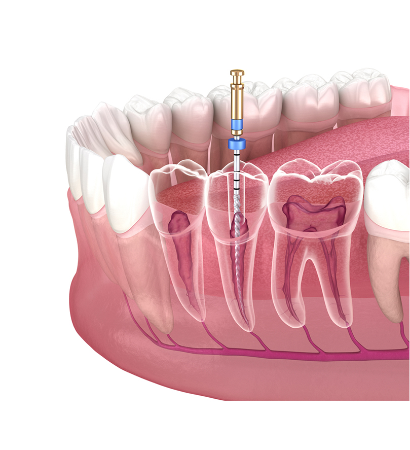 Dụng cụ nội nha