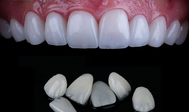 LỰA CHỌN KEO DÁN VENEER: BỀN ĐẸP - TỰ NHIÊN