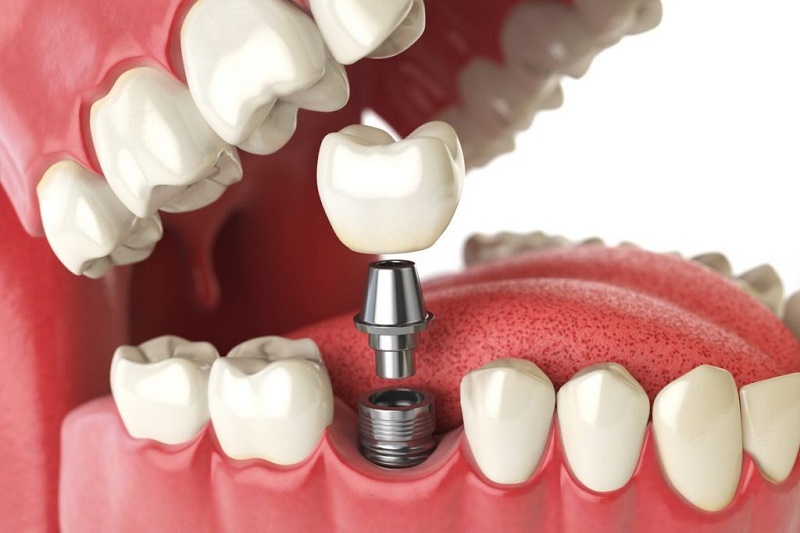 IMPLANT NHA KHOA - LỰA CHỌN TỐI ƯU CHO PHỤC HÌNH RĂNG LÂU DÀI